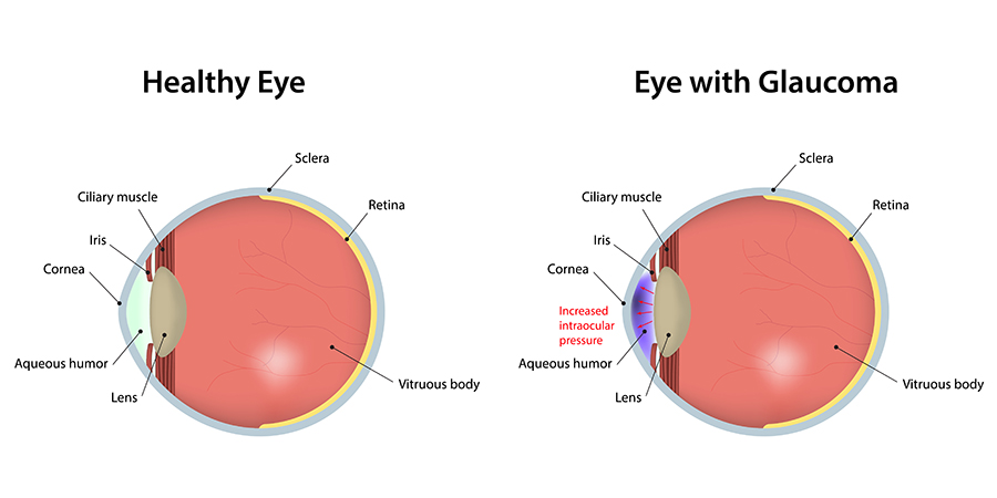 Healthy Eye vs Glaucoma