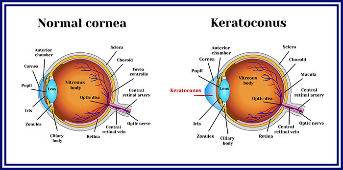 Normal Cornea vs Keratoconus