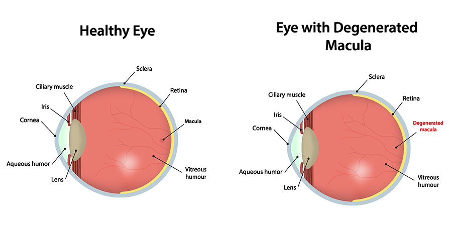 Healthy Eye vs Macular Degeneration