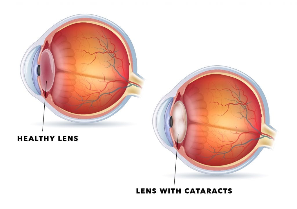 Healthy Lens Vs Cataract